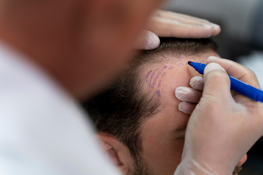 Men’s Hair Transplant